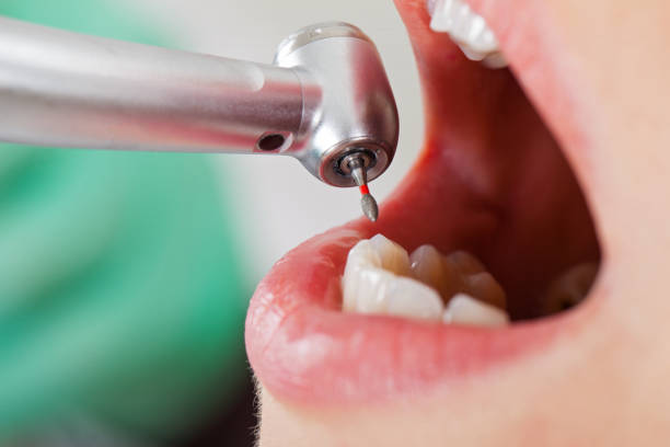 Best Emergency Tooth Extraction in Washington, UT